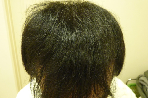 男性薄毛（AGA）治療症例